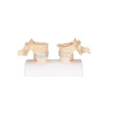 Osteoporose Modell des 11. und 12. Brustwirbels