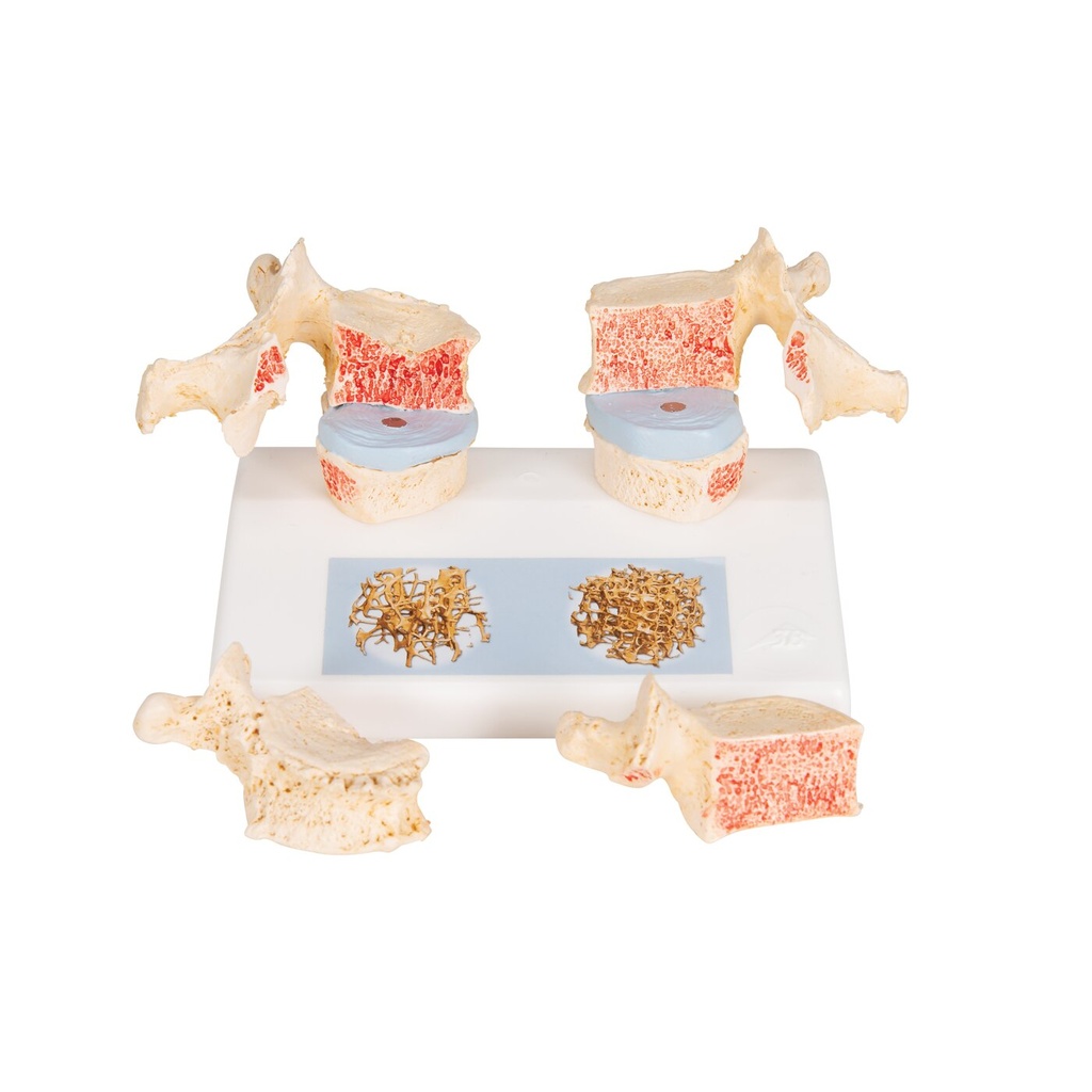 Osteoporose Modell des 11. und 12. Brustwirbels