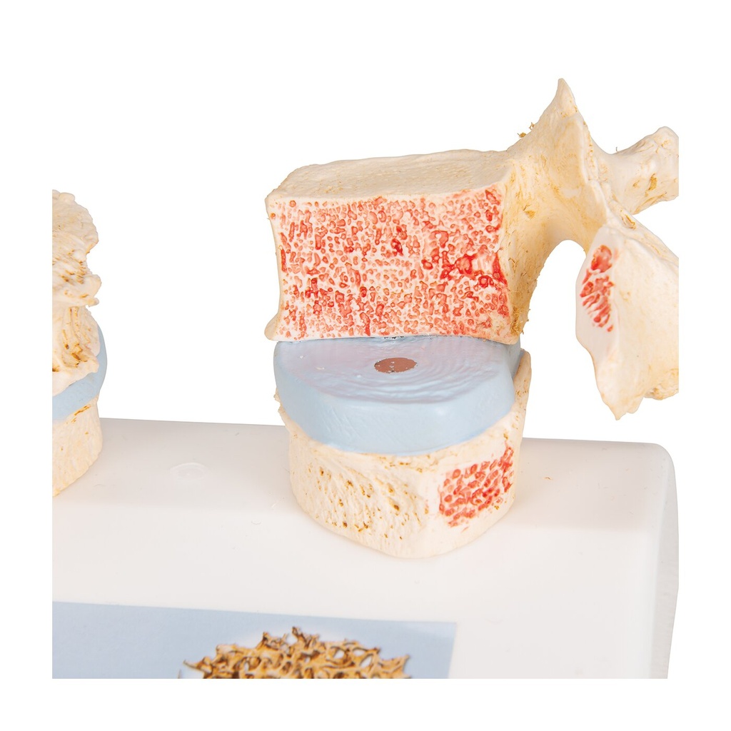 Osteoporose Modell des 11. und 12. Brustwirbels