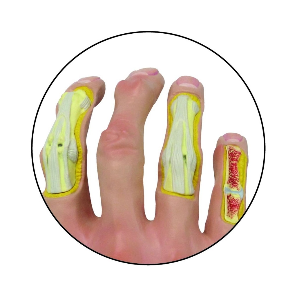 Modell einer Hand mit Osteoarthritis Modell einer Hand mit Osteoarthritis