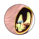 Modell einer Hand mit Osteoarthritis Modell einer Hand mit Osteoarthritis