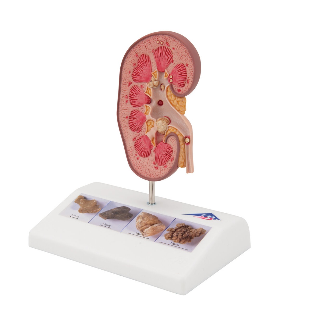 Nierensteinmodell Nierensteinmodell