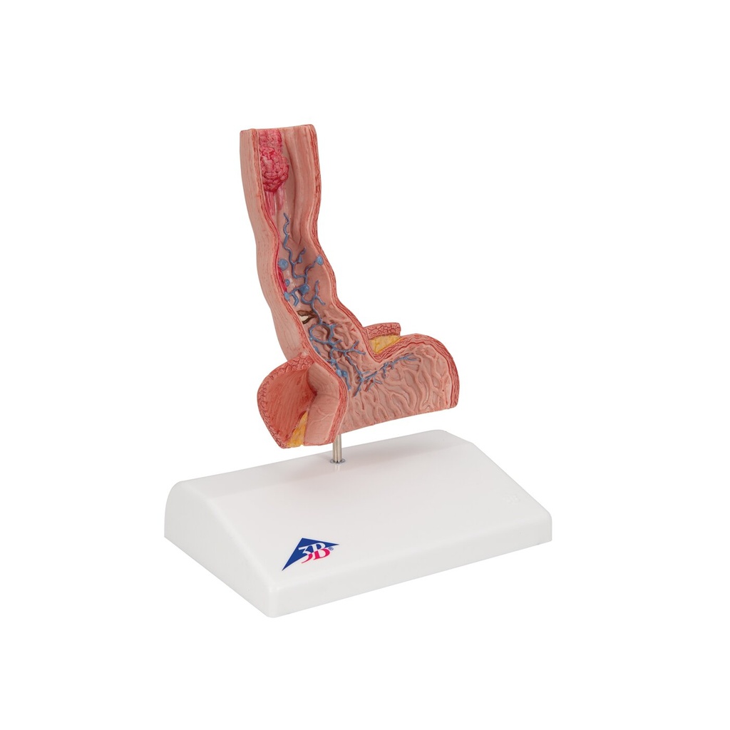 Pathologisches Modell der Speiseröhre Pathologisches Modell der Speiseröhre