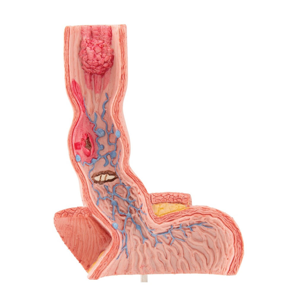 Pathologisches Modell der Speiseröhre Pathologisches Modell der Speiseröhre