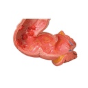 Pathologisches Darmmodell (Dick- und Enddarm) Pathologisches Darmmodell (Dick- und Enddarm)