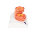 COPD Lungenmodell COPD Lungenmodell