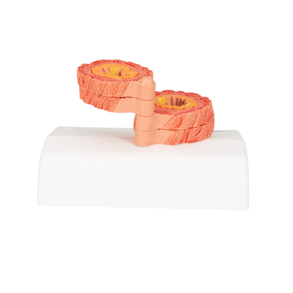 COPD Lungenmodell COPD Lungenmodell