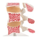 Osteoporose Modell mit 3 Lendenwirbeln, auf Stativ