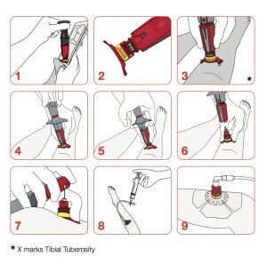 NIO-Pediatric Neues Intraossäres Infusionssystem NIO-Pediatric Neues Intraossäres Infusionssystem