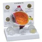 Modell Auge mit grauem Star