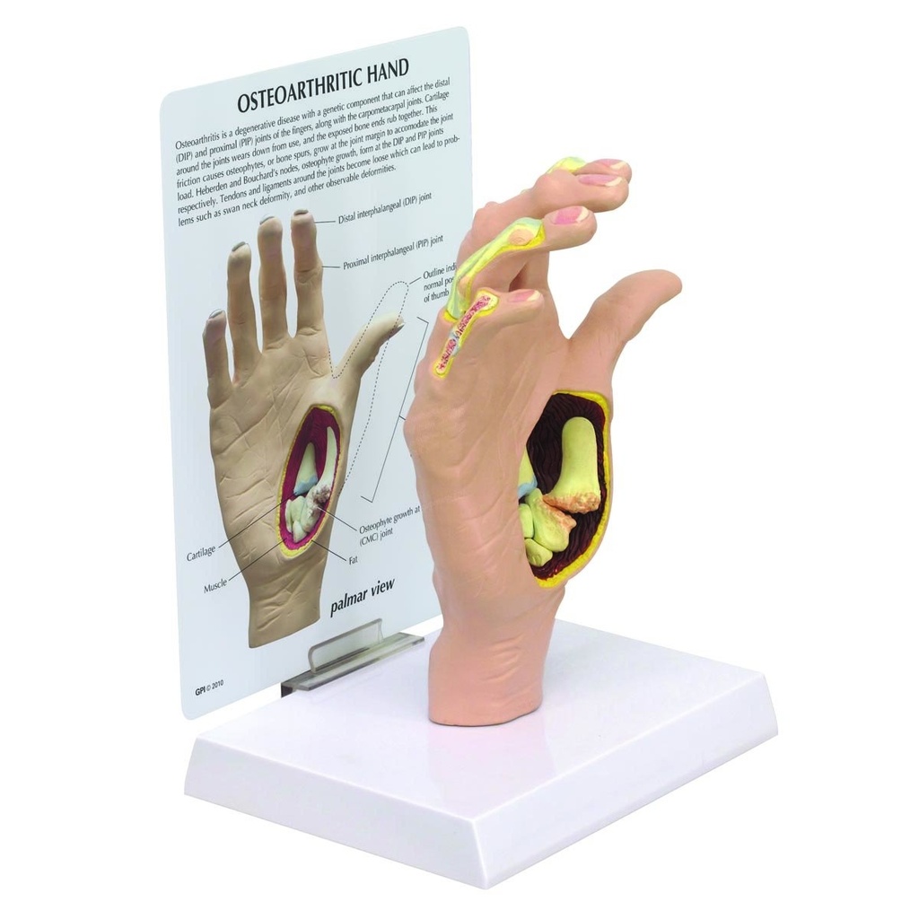 Modell einer Hand mit Osteoarthritis