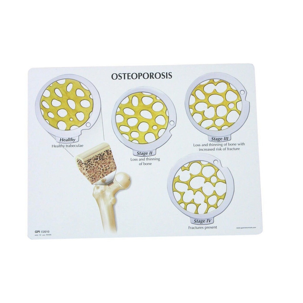 Knochenkrebs­-Scheibenset - 4 Stadien der Osteoporose