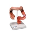 Pathologisches Darmmodell (Dick- und Enddarm)