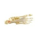 Modell des Fusses/Knöchels mit Plantarfasziitis