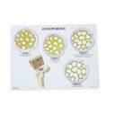 Knochenkrebs­-Scheibenset - 4 Stadien der Osteoporose